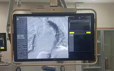 PROFESIONALES DEL HOSPITAL DEL BICENTENARIO DE ESTEBAN ECHEVERRÍA REALIZARON UN EXITOSO IMPLANTE DE ENDOPRÓTESIS AÓRTICA